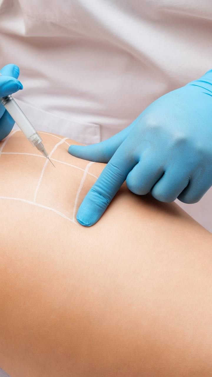 Why Butt Body Fillers Are the Secret to a Perfect Silhouette